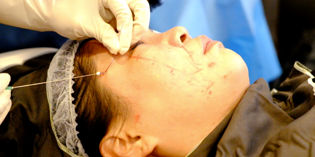 Non-Surgical Brow Lift Using Barbed Suture Technology (Thread Lift)